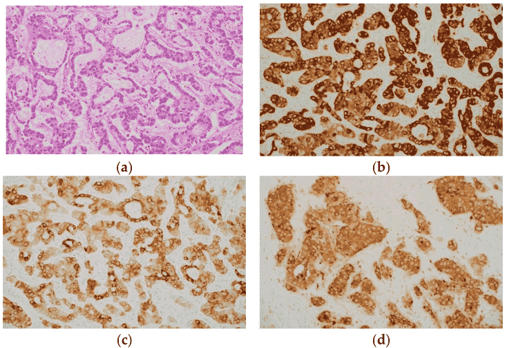 Adult granulosa cell tumor A exhibiting diffuse positivity with inhibin B