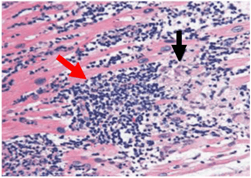 Histological samples from patients with myocarditis.