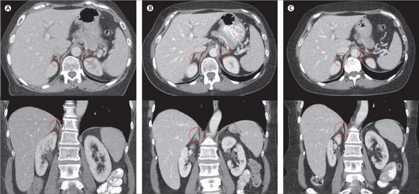 CT scans of the abdomen show the change in the size of adrenal glands (circled) of adrenalitis during treatment.