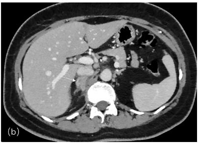 Fig.1 Imaging features of adrenal masses. (Dai, et al., 2022)