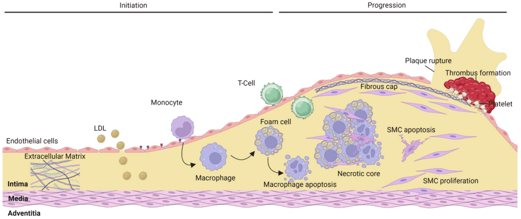 Fig.1 Steps in atherosclerosis initiation and progression. (Drysdale, et al., 2023)
