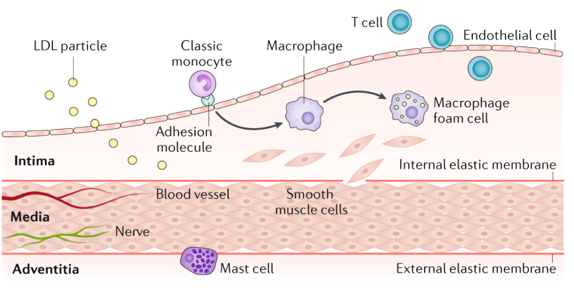 The progression of atherosclerosis.