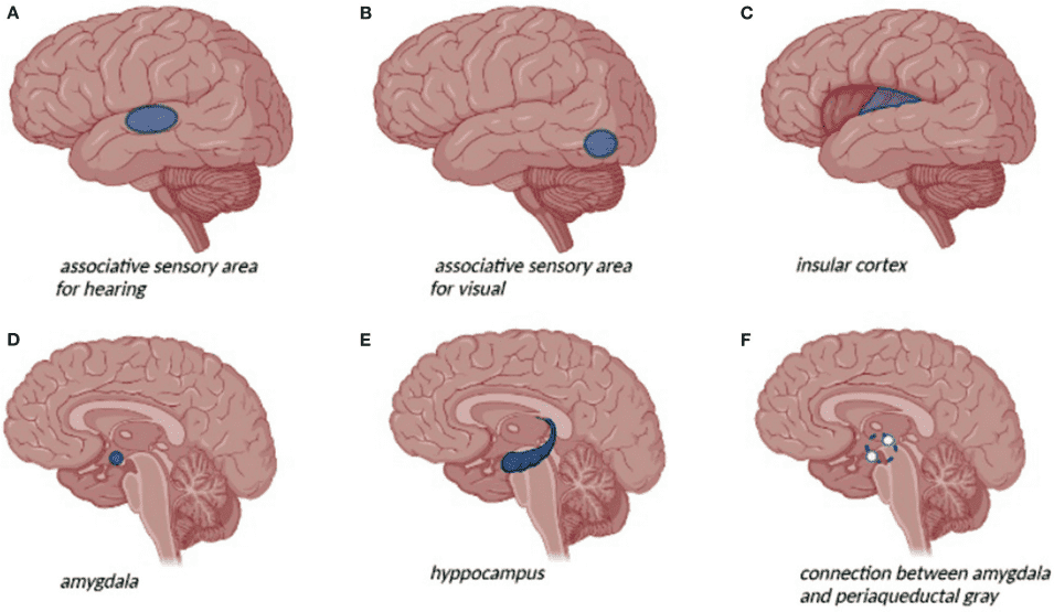 Fig.1 Brain anatomical changes in epilepsy. (Vinti, et al., 2021)