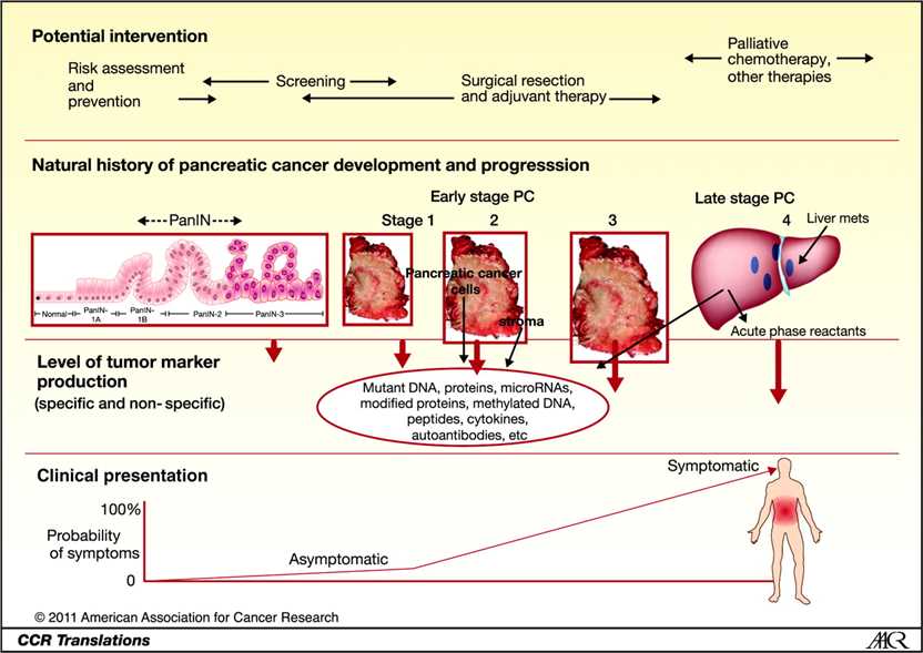 Overview of early detection for PC.