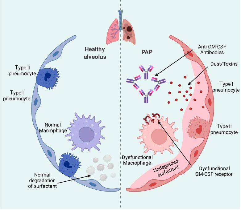 Fig.1 The PAP syndrome. (Cimpoca, et al., 2022)