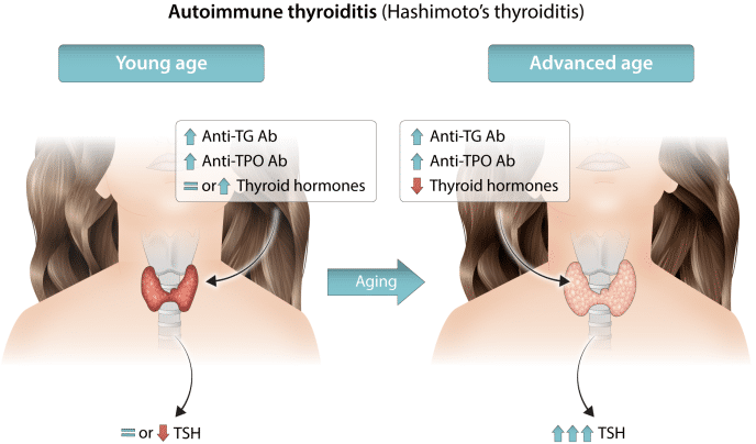 Fig.1 The link between autoimmune thyroiditis and phenotype. (Palomba, et al., 2023)