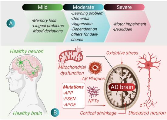 Alzheimer's disease.
