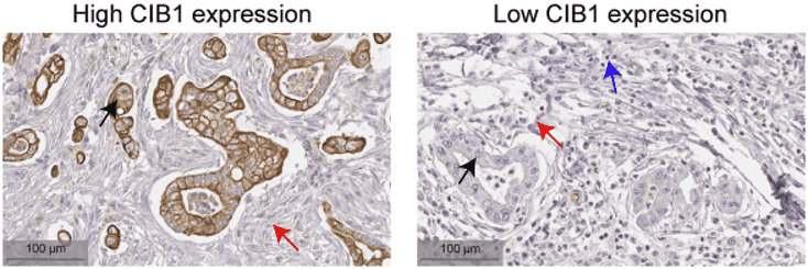 Fig.1 High expression of CIB1 in pancreatic ductal adenocarcinoma. (Ma, et al., 2023)