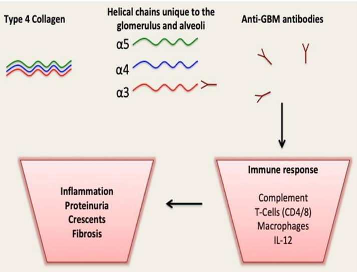 Fig.1 Autoimmunity in anti-GBM disease. (Dowsett and Louise, 2022)