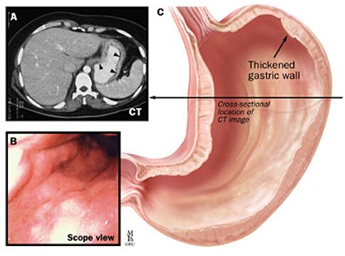 Gastric cancer disease.
