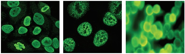 Fig.1 Classic anti-nuclear antibody patterns. (Pradhan, et al., 2010)