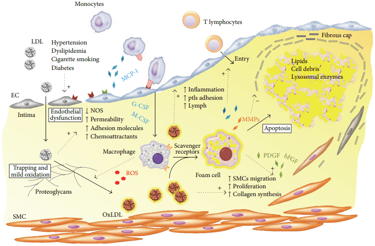 Macrophage trapping as a mechanism of atherosclerosis. 