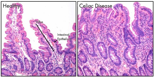 Fig.1 A representation of (left) healthy and (right) damaged villi. (https://commons.wikimedia.org/wiki/File:Histopathology_of_villous_atrophy_in_celiac_disease.jpg)