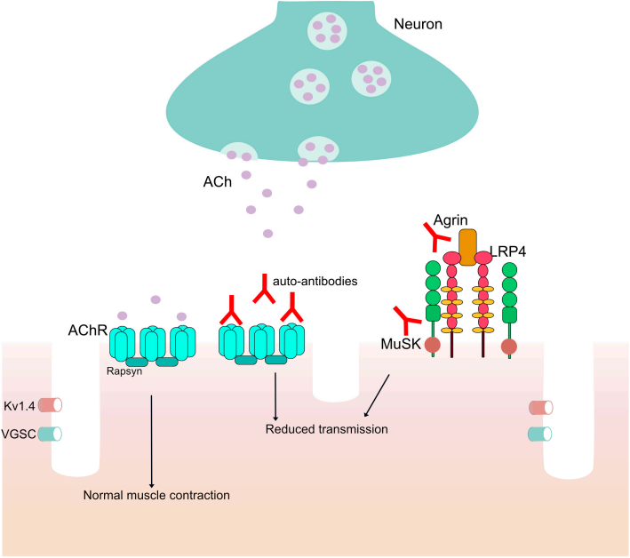 Fig.1 Reduced signal transmission in the NMJ induced by anti-LRP4 auto-antibodies. (Golfinopoulou, et al., 2023)