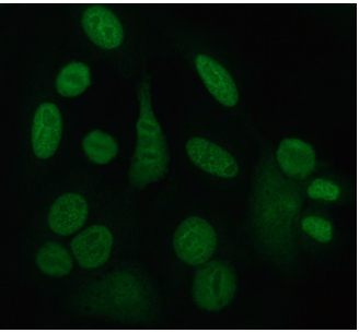 Fig.1 Immunofluorescence pattern of Ro and La antibodies. (https://commons.wikimedia.org/wiki/File:SSA_SSB_ANA.jpg)