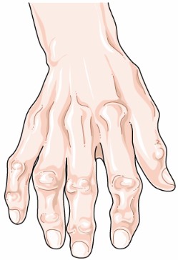 Fig.1 Osteoarthritis illustration. (By Laboratoires Servier, CC BY-SA 3.0, https://commons.wikimedia.org/wiki/File:Rheumatology_-_Tendonitis_1_--_Smart-Servier.png)