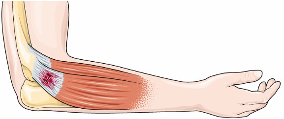 Fig.2 Tendonitis illustration. (By Laboratoires Servier, CC BY-SA 3.0, https://commons.wikimedia.org/wiki/File:Rheumatology_-_Osteoarthritis_2_--_Smart-Servier.png)