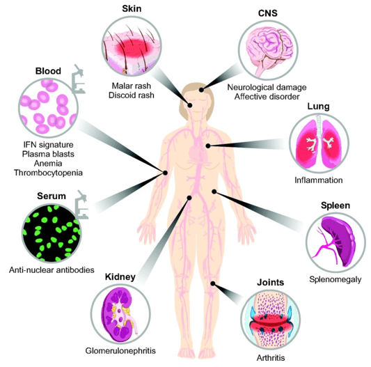 Multi-organ involvement in systemic lupus erythematosus.