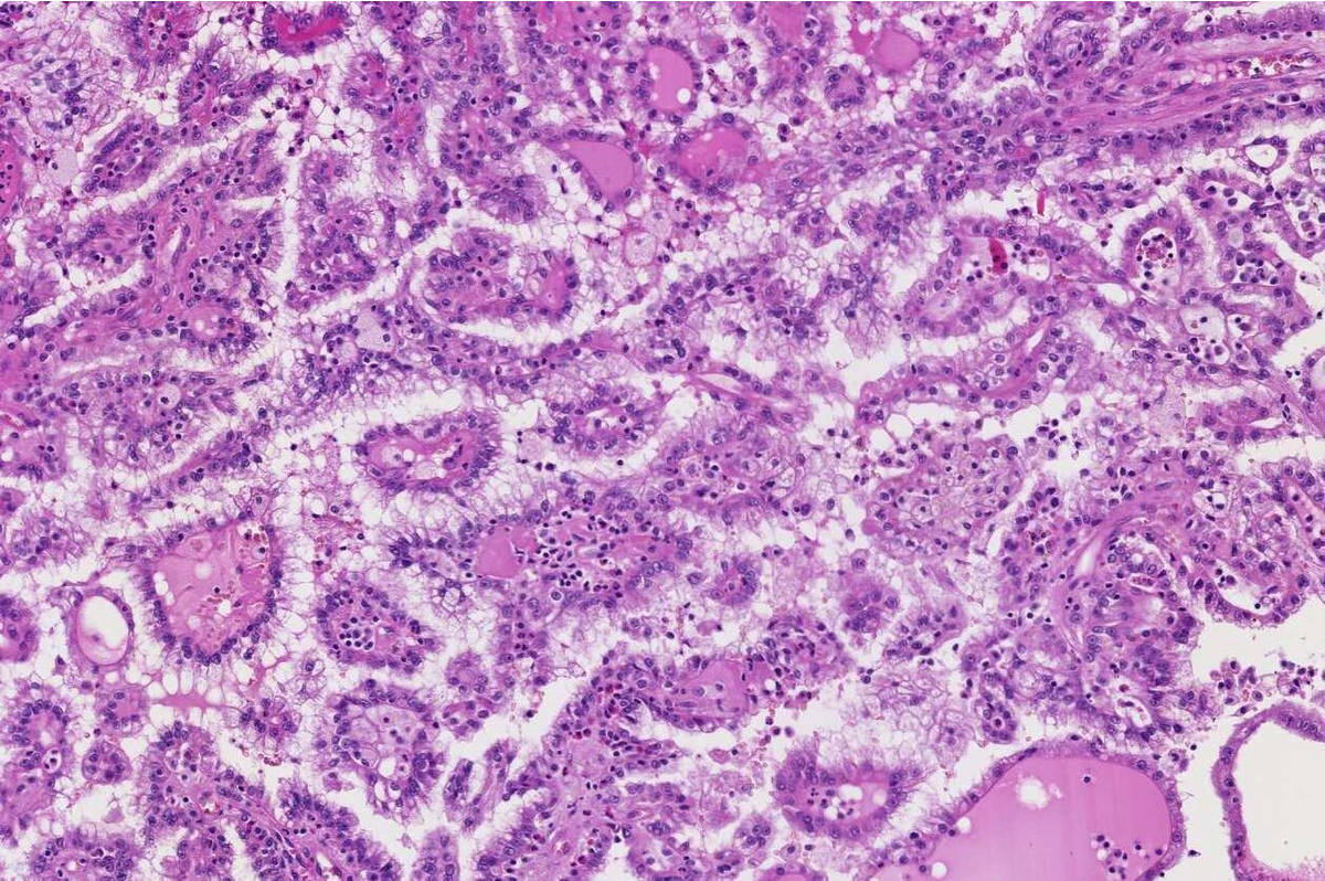 Plasmacytoma ultramini.