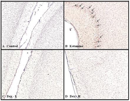 Activated caspase 3 (AC3) immunostained photomicrographs of the frontal cortex of fetal monkey brains of untreated control (A) and monkevs treated with ketamine (B). low-dose dexmedetomidine (C). and high-dose dexmedetomidine (D). Arrows in Fig.2B indicate AC3-positive cells.10X magnification.