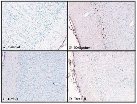 Immunohistochemical TUNEL-label photomicrograhs of the frontal cortex of fetal monkey brains of untreated control(A and monkeys treated with ketamine (B), low-dose dexmedetomidine (C), and high-dose dexmedetomidine (D). TUNEL. labeled cells as a result of ketamine treatment are clearly seen as brown cells in Fig. 4B. 20X magnification.