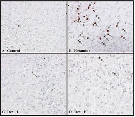 Immunohistochemical TUNEL-label photomicrograhs of the frontal cortex of fetal monkey brains of untreated control(A and monkeys treated with ketamine (B), low-dose dexmedetomidine (C), and high-dose dexmedetomidine (D). TUNEL. labeled cells as a result of ketamine treatment are clearly seen as brown cells in Fig. 4B. 20X magnification.