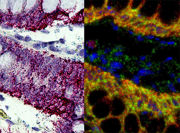 RNA in situ hybridization-Human Melanoma FFPE Tissue Section.