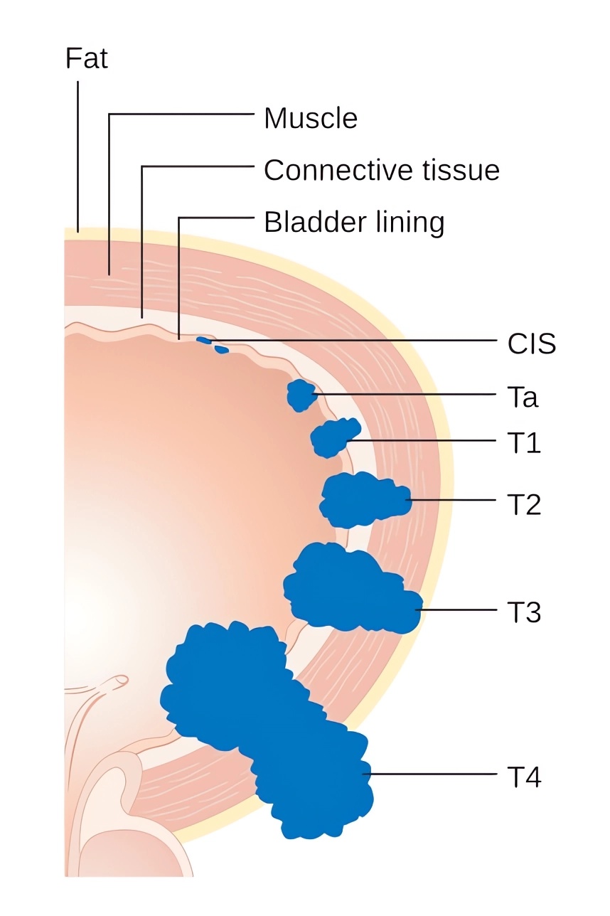 Diagram showing the T stages of bladder cancer.