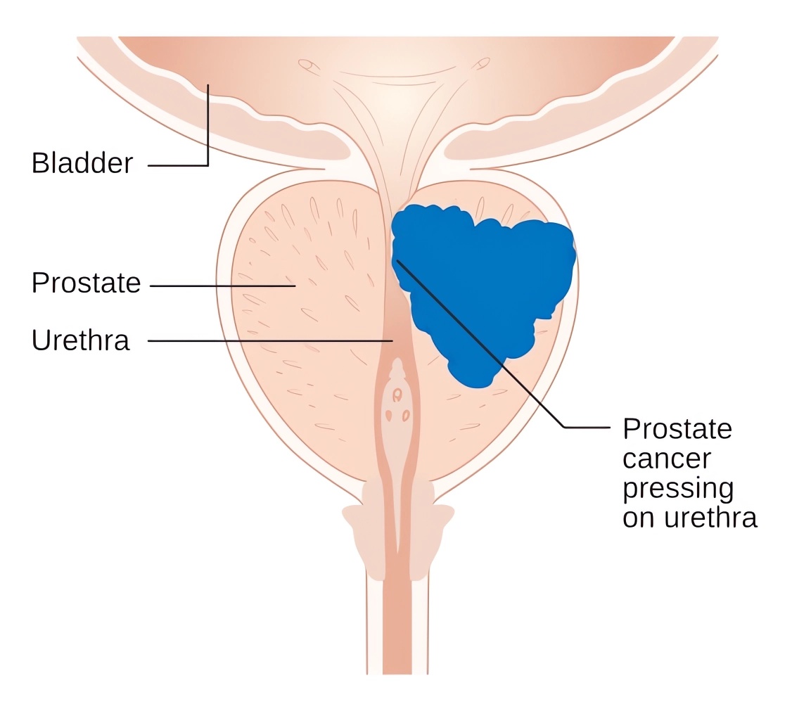 Schematic representation of the location of bladder cancer in men.
