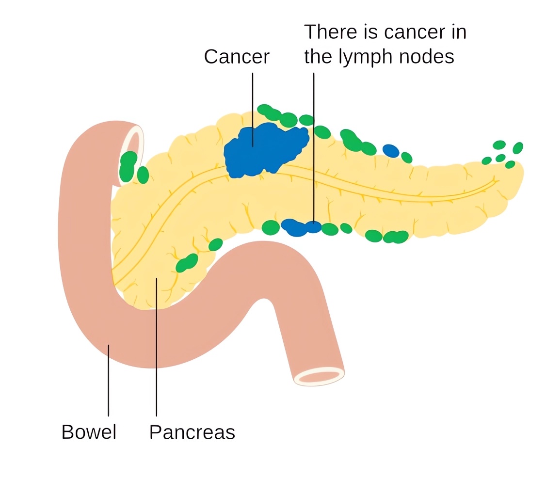 Schematic representation of the location of pancreatic cancer.