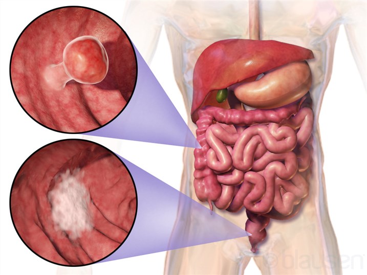 Schematic representation of the location of colorectal cancer. (OA Literature)