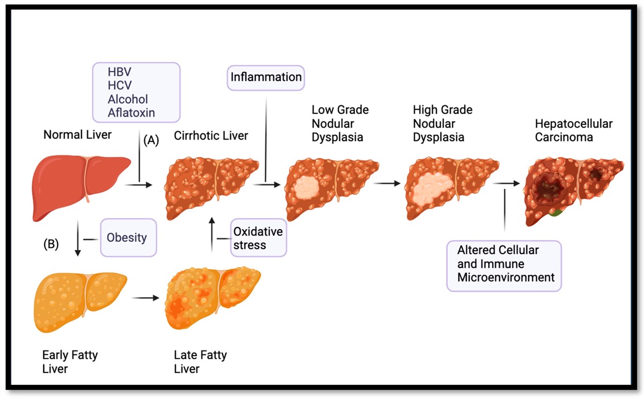 HCC develops gradually from liver cirrhosis or fatty liver, and undergoes LGND and HGND in the middle. (OA Literature)