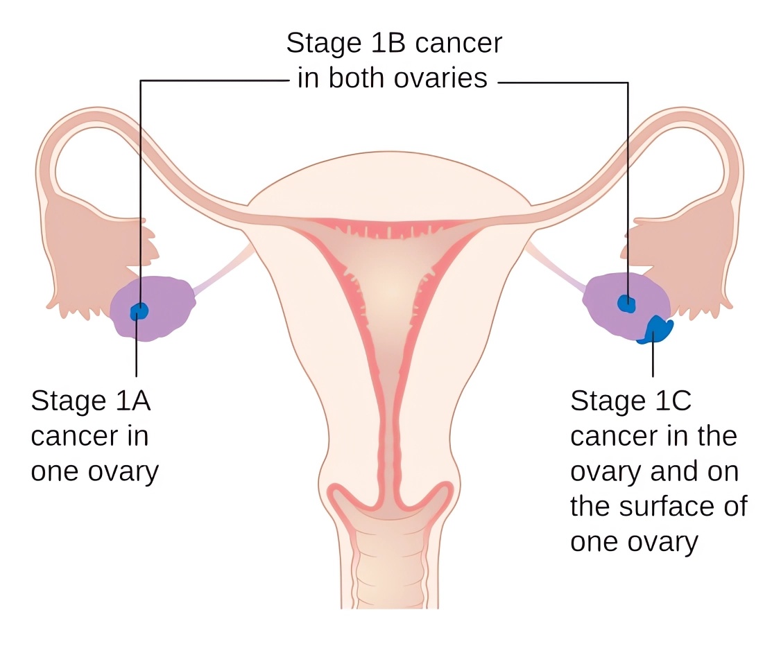 Schematic representation of symptoms in ovarian cancer stage 1A to 1C.