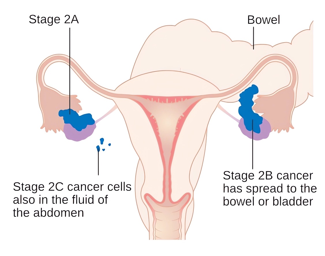 Ovarian cancer in stage 2A-2C can show intestinal metastasis.