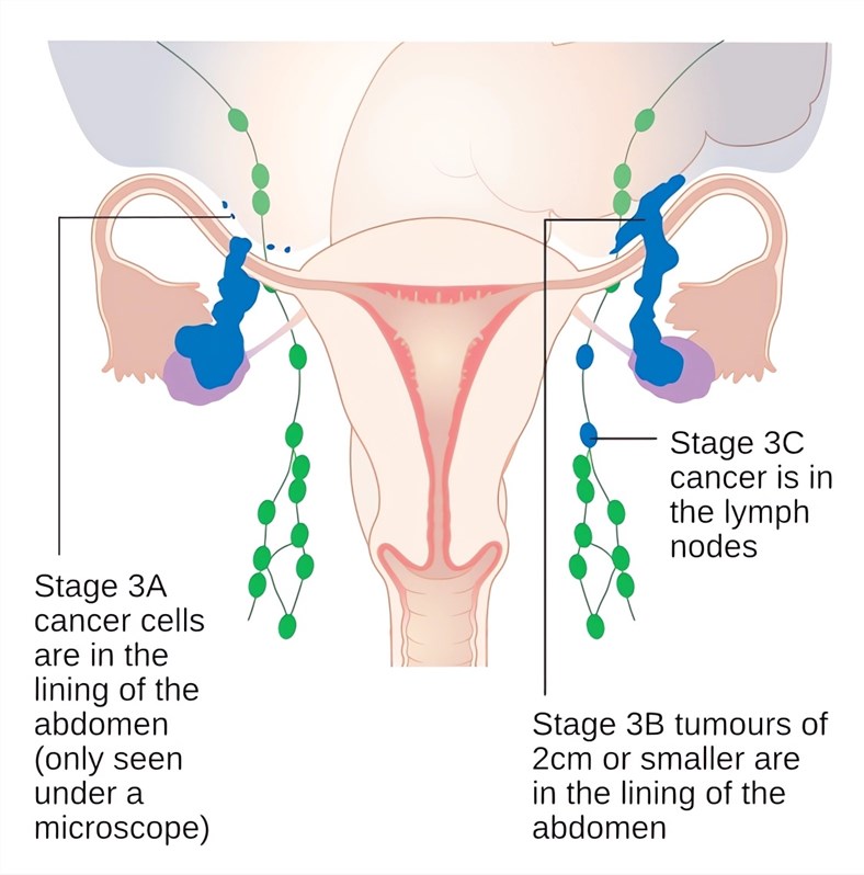 Stage 3A-3C ovarian cancer can show lymph node metastasis and tumor size changes.