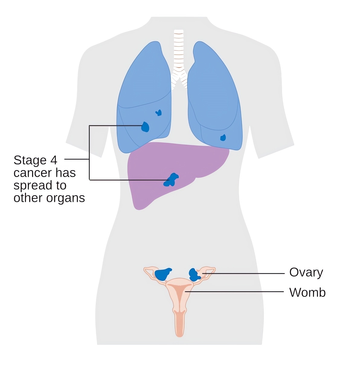 Stage 4 ovarian cancer can present with lung metastasis.