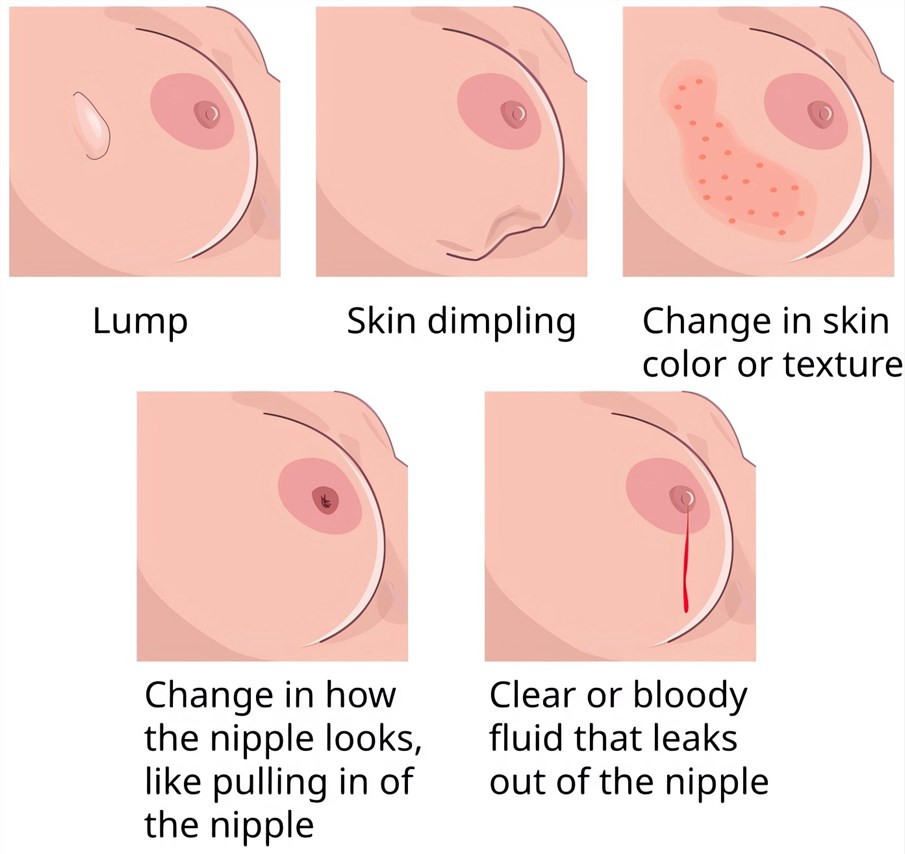 Pre-breast cancer manifestations, including nipple depression, nipple discharge and other symptoms.