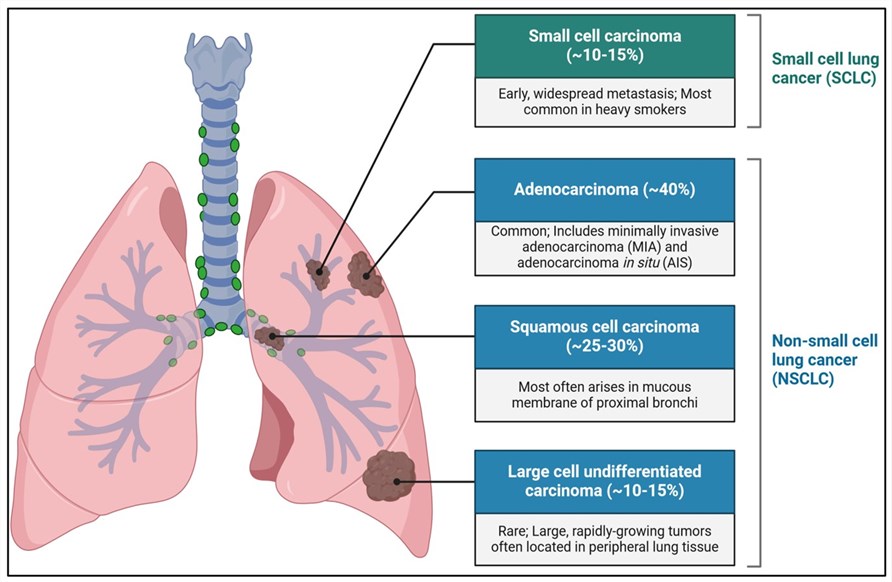 Several common lung cancers. (OA Literature)