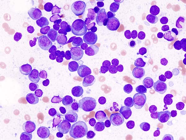 Multiple myeloma cells were stained using the May-Grunwald-Giemsa method and then observed using microscopy.