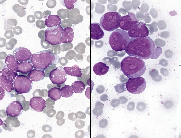 The leukemic cells were stained by Wright-Giemsa stain and observed by microscope.