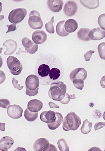 Myelodysplastic syndrome cells were stained by Wright-Giemsa method and observed by microscopy.