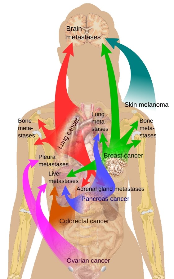 Common metastatic sites of different tumors.