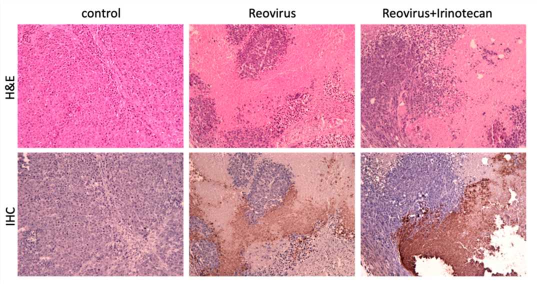 H&E staining and immunohistochemical staining of the tumor. (OA Literature)