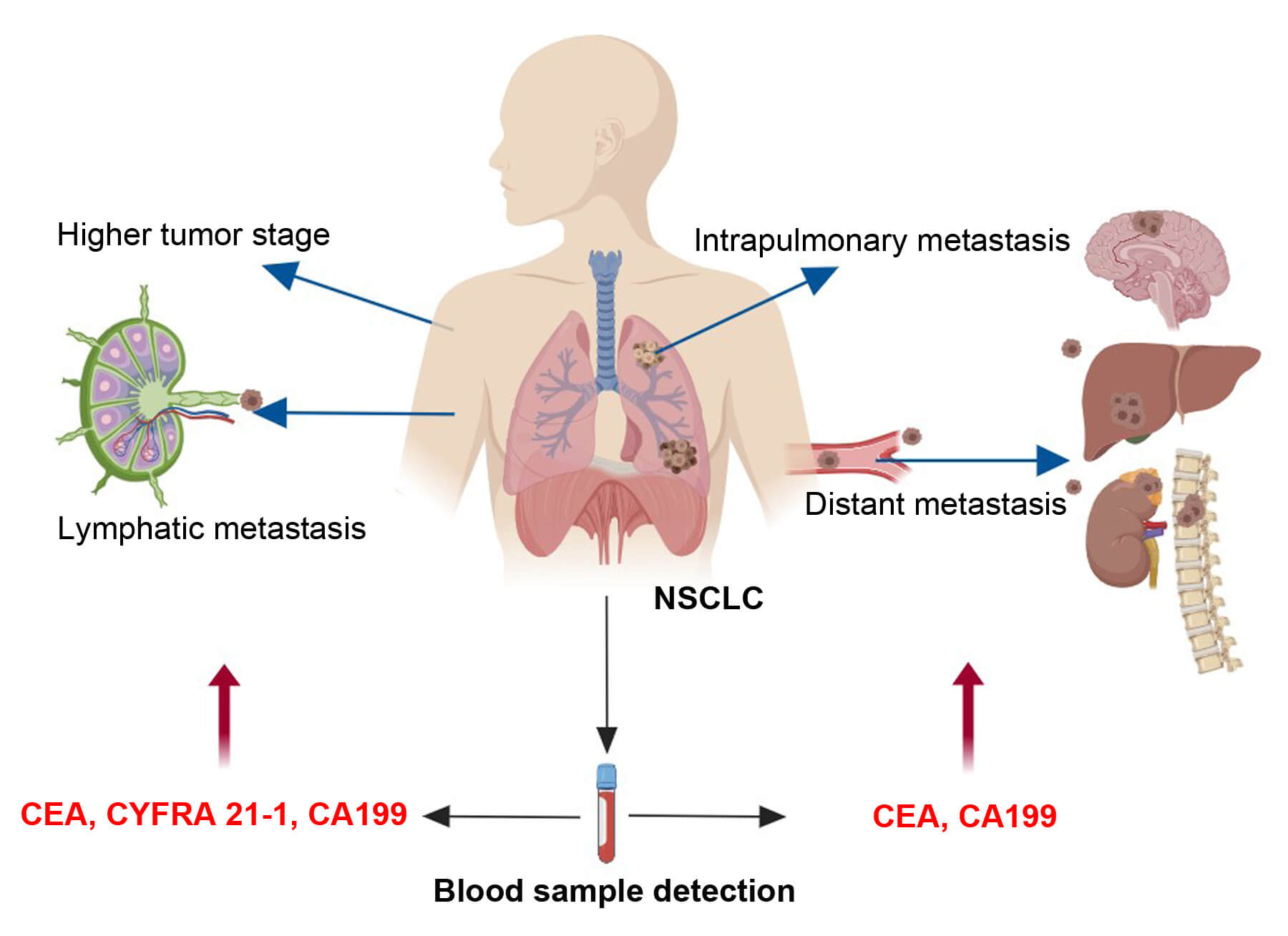 CEA was used for staging of non-small cell lung cancer. (OA Literature)