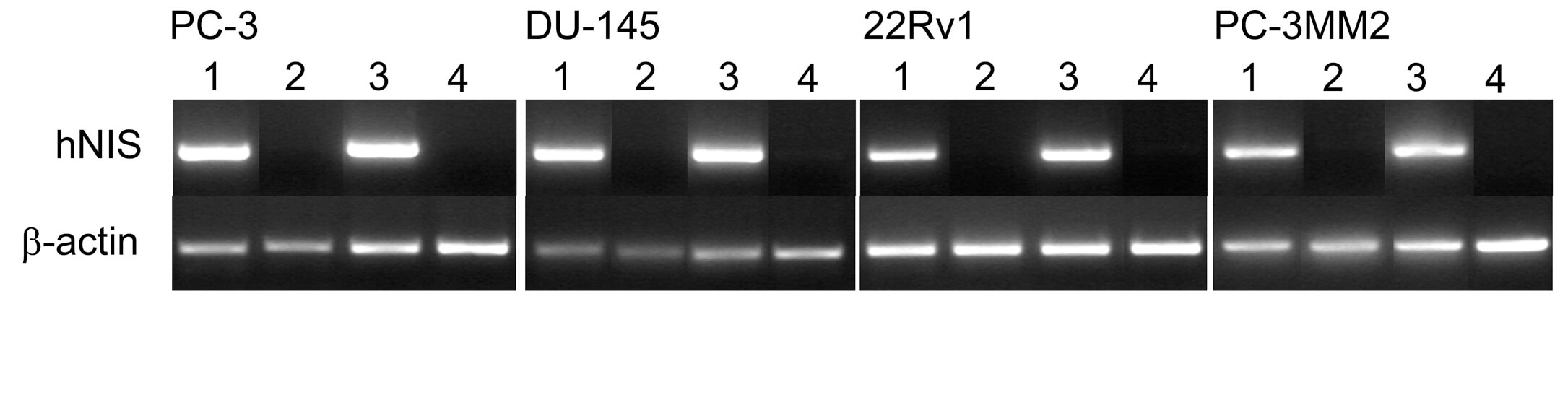 To test the ability of the virus to induce hNIS expression, tumor cells were infected with the virus and the cells were harvested for hNIS RT-PCR. (OA Literature)