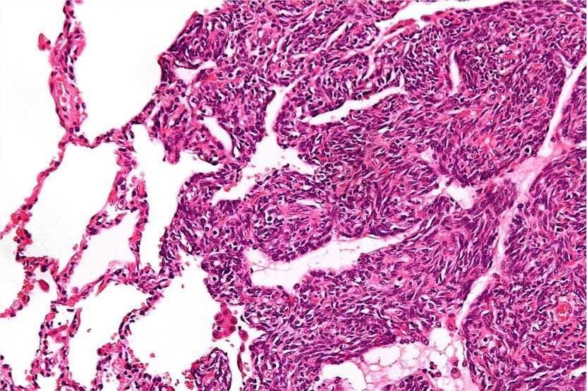 High magnification micrograph of a monophasic synovial sarcoma.