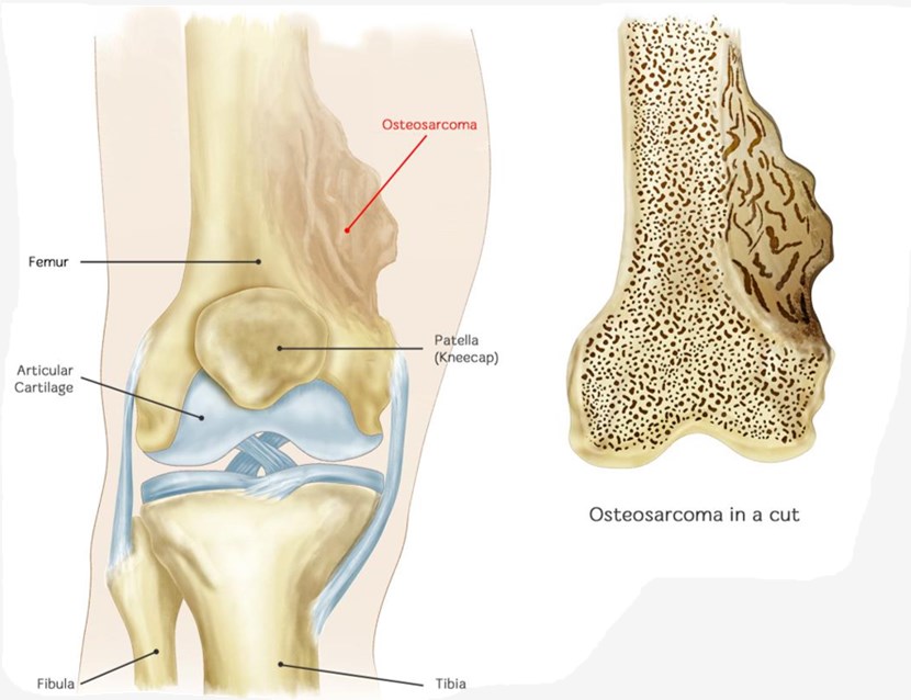 Osteosarcoma (OS).
