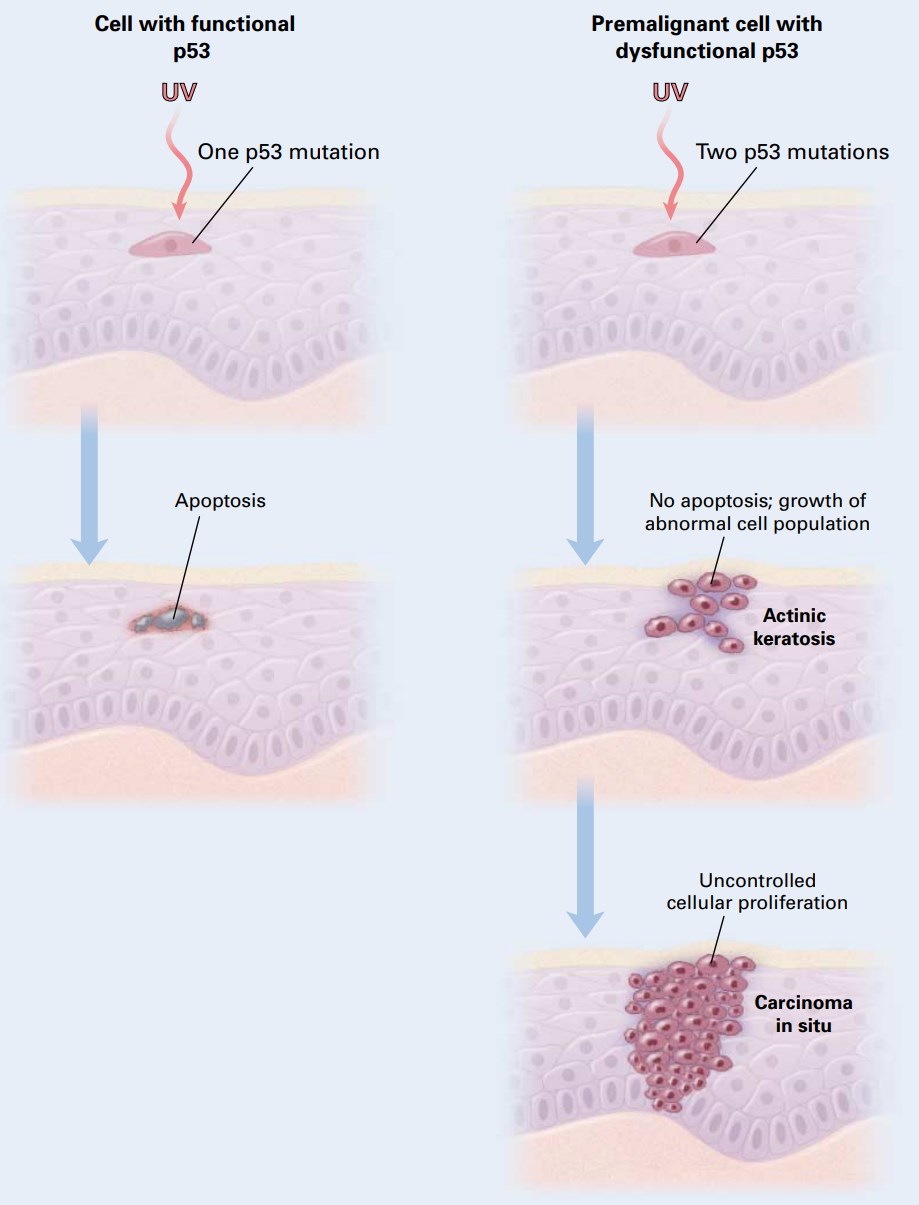 Mechanism of skin cancerization induced by ultraviolet rays.
