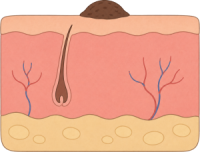 Melanoma