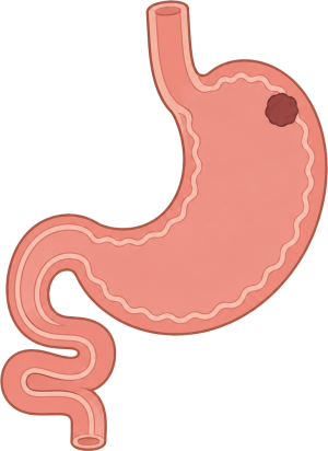 Gastrointestinal Cancers